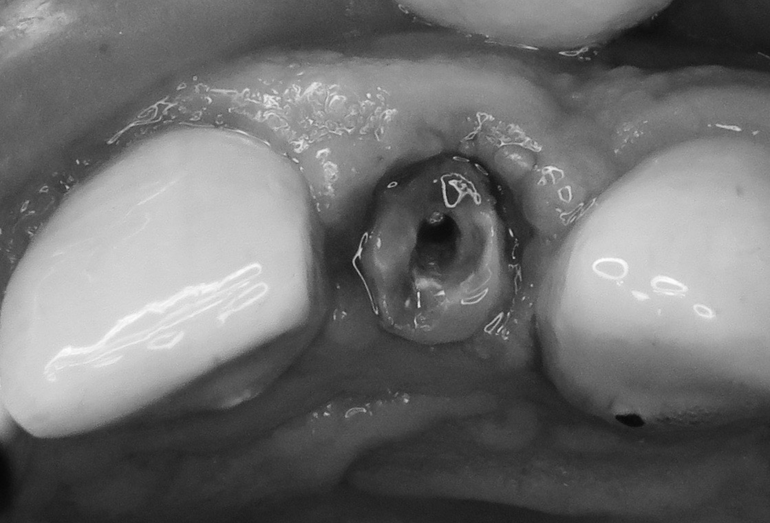 Grau wird wurzelbehandelter zahn 
