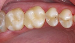 Zahnfarbene Füllungen
